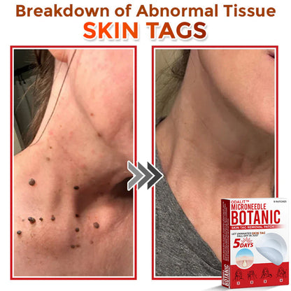 👩‍⚕️𝑶𝒇𝒇𝒊𝒄𝒊𝒂𝒍 𝑺𝒕𝒐𝒓𝒆 | ODALIT™ Gentle Microneedle Patches for Skin Tag & Mole Removal