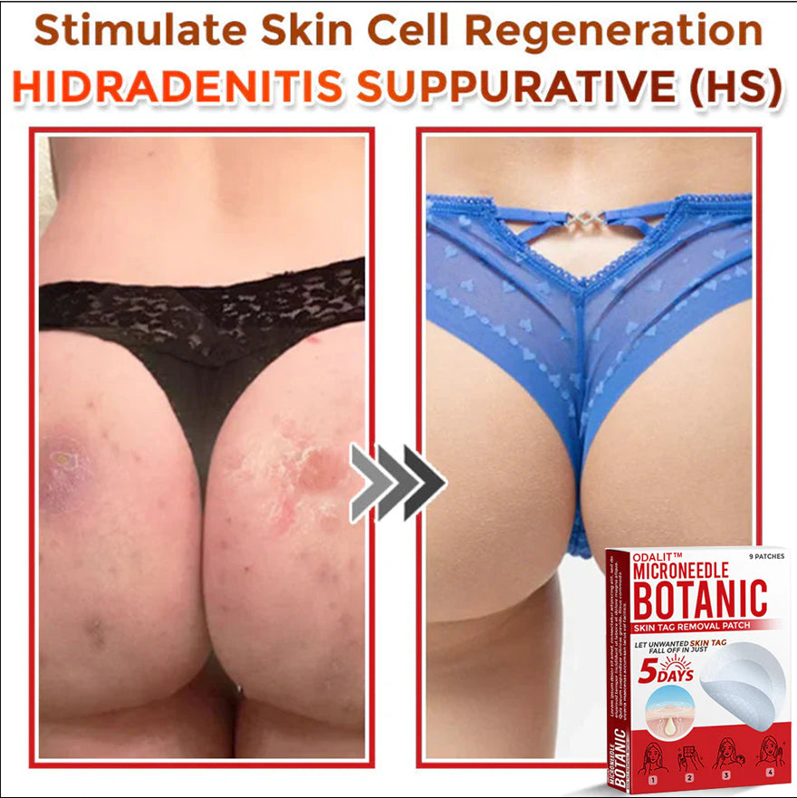 👩‍⚕️𝑶𝒇𝒇𝒊𝒄𝒊𝒂𝒍 𝑺𝒕𝒐𝒓𝒆 | ODALIT™ Gentle Microneedle Patches for Skin Tag & Mole Removal