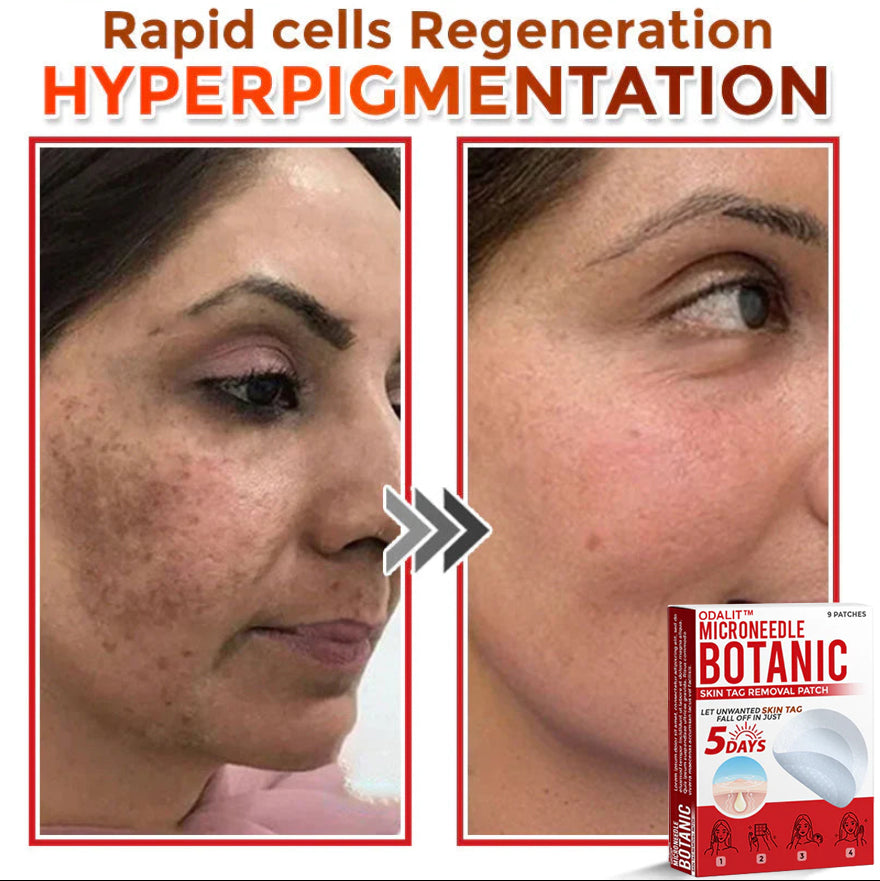 👩‍⚕️𝑶𝒇𝒇𝒊𝒄𝒊𝒂𝒍 𝑺𝒕𝒐𝒓𝒆 | ODALIT™ Gentle Microneedle Patches for Skin Tag & Mole Removal