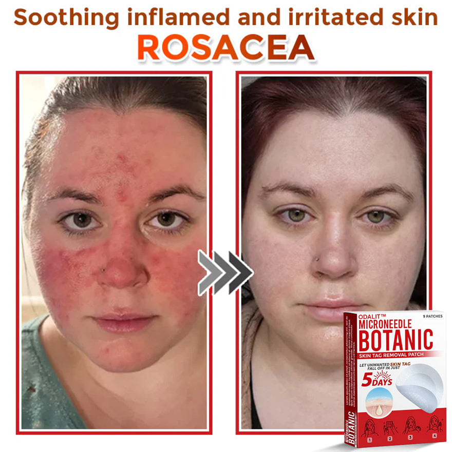 👩‍⚕️𝑶𝒇𝒇𝒊𝒄𝒊𝒂𝒍 𝑺𝒕𝒐𝒓𝒆 | ODALIT™ Gentle Microneedle Patches for Skin Tag & Mole Removal