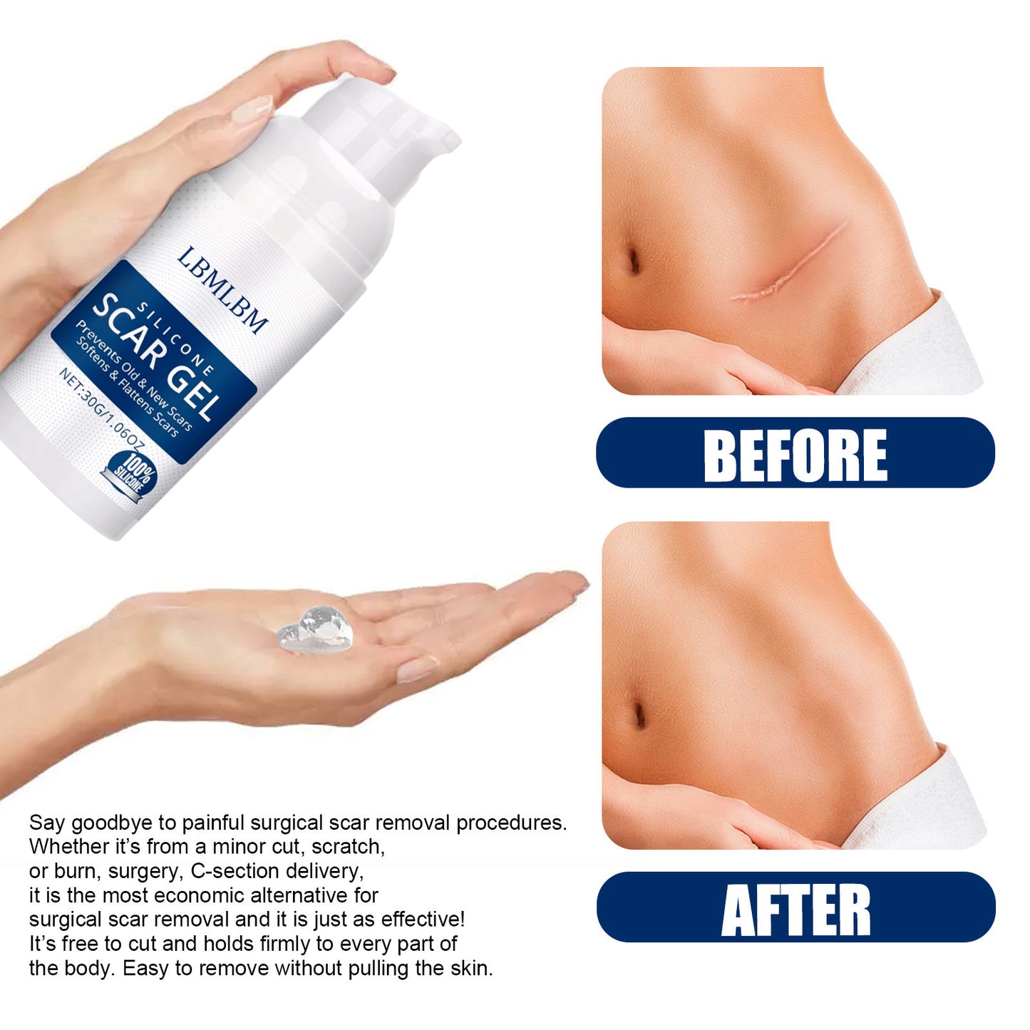 💥50% OFF💥LBMLBM™ Medical-Grade Silicone Scar Gel