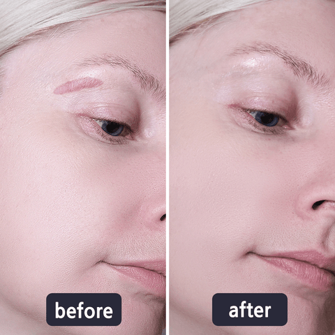 💥50% OFF💥LBMLBM™ Medical-Grade Silicone Scar Gel