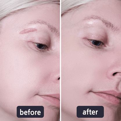 💥50% OFF💥LBMLBM™ Medical-Grade Silicone Scar Gel