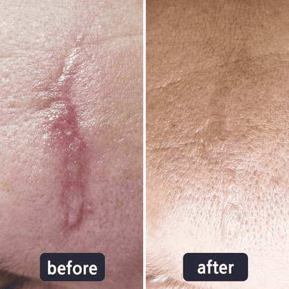 💥50% OFF💥LBMLBM™ Medical-Grade Silicone Scar Gel