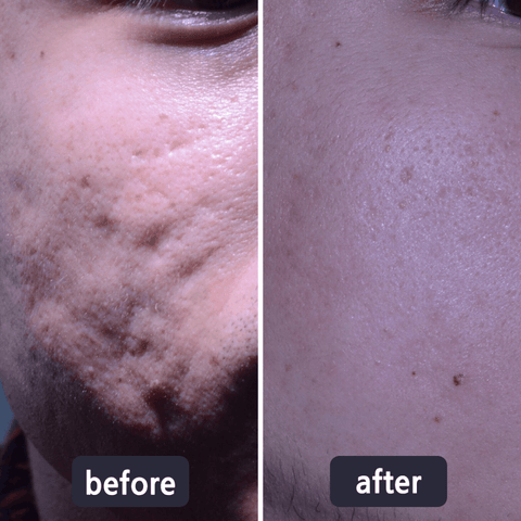 💥50% OFF💥LBMLBM™ Medical-Grade Silicone Scar Gel