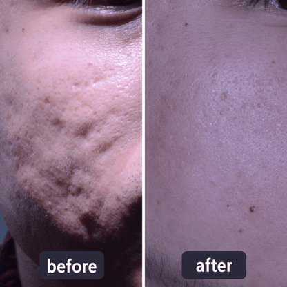 💥50% OFF💥LBMLBM™ Medical-Grade Silicone Scar Gel