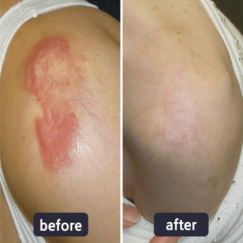 💥50% OFF💥LBMLBM™ Medical-Grade Silicone Scar Gel